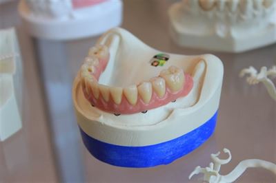 Tandkødsbetændelse: en stille trussel mod din mund